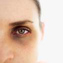 woman-black-eye