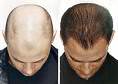 hair-transplant