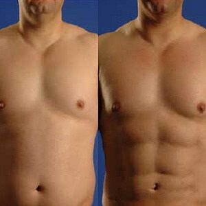 man abdominal implants